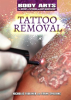 Tattoo_Removal